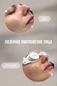 Фракционное омоложение лазером в Омске