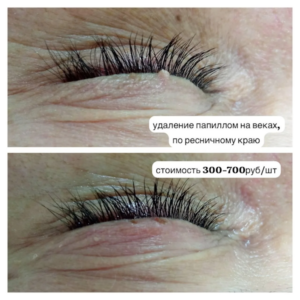 Удаление папиллом
