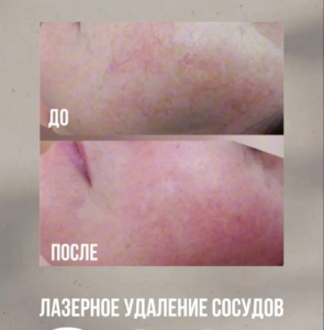 Лазерное удаление сосудов