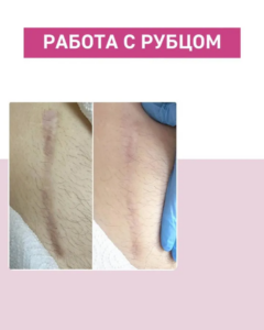 Лазерная шлифовка Рубцов в Омске