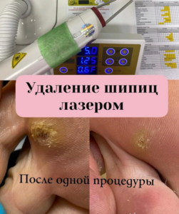 Удаление шипицы лазером