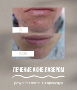 Лазерное удаление постакне